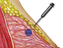 After allowing a few minutes for the anesthetic to take effect, the surgeon will insert the biopsy needle and guide it toward the lump.