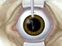 With the tip of the injector inside the eye, the surgeon slowly injects the new lens where it unfolds into position.