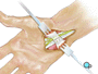 Skin and other tissue will be carefully drawn aside to expose the carpal ligament.