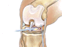 After inspecting the extent of the damage to the meniscus, your doctor will repair the meniscus with tiny staples,