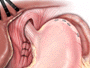 Some hiatal hernias can cause persistent and painful acid reflux and your doctor may decide to correct the problem surgically. In this case, the surgeon divides and separate the arteries that supply blood to the top of the stomach.