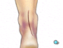 an incision will be made in the long axis of the ankle over the injured tendon.