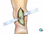 The incision is carried down through the skin, exposing the underlying tendon sheath.