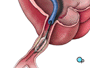 The balloon is briefly inflated. As it expands, it squeezes the plaque deposits against the wall of the artery. It also stretches the artery wall and enlarges the channel through which blood flows.