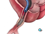 Once this tube has been placed in the center of now widened area of the artery, the balloon is briefly inflated. The stent expands until it hugs the walls of the artery.