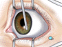 When the operative field is numb, the doctor will carefully remove the epithelium, or top layer of cells, exposing the stroma - the non-cellular portion of the cornea.