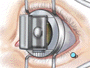 This tiny instrument will carefully create a thin corneal flap ...