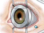 Underneath this flap the inner layer of the cornea, called the stroma, is exposed.