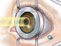 In a very small number of cases, follow up surgery may be required to fine-tune the correction. This may mean repeating the procedure in order to complete the reshaping of the cornea.