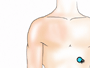 To perform arthroscopic surgery your doctor will make three small, button-hole sized incisions in the area around the shoulder.