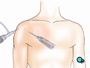 ... the instruments are removed and the clear fluid is allowed to drain from the shoulder.