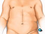 the surgical team will make a vertical incision down the middle of your abdomen.