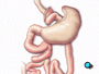 The other end is now attached to the small stomach pouch. A new route for food passing from the esophagus into the intestines has now been created.