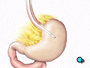 Once the team has a clear view of the stomach, your doctor will insert a special tube into your mouth and throat. The surgical team guides the tube into your abdomen until the tip reaches the top of the stomach.