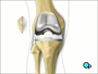 Finally, your doctor places a spacer on the tibia surface.